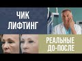 ЧИК ЛИФТИНГ 🔥 МАЛЯРНЫЕ МЕШКИ, НОСОГУБКИ, НОСОСЛЕЗНАЯ БОРОЗДА  🔥 ПОМОЖЕТ ЛИ УБРАТЬ?