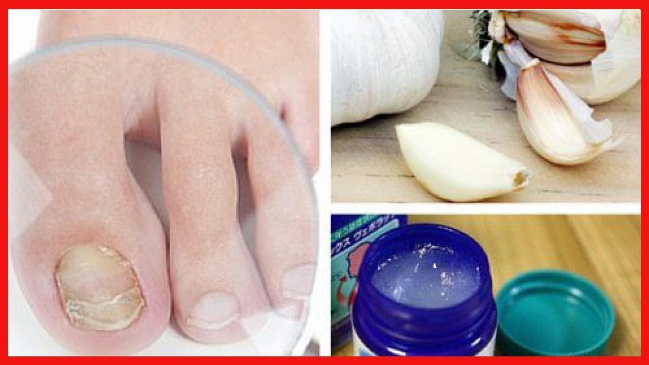 7 remèdes maison pour lutter contre les mycoses des ongles aux pieds et