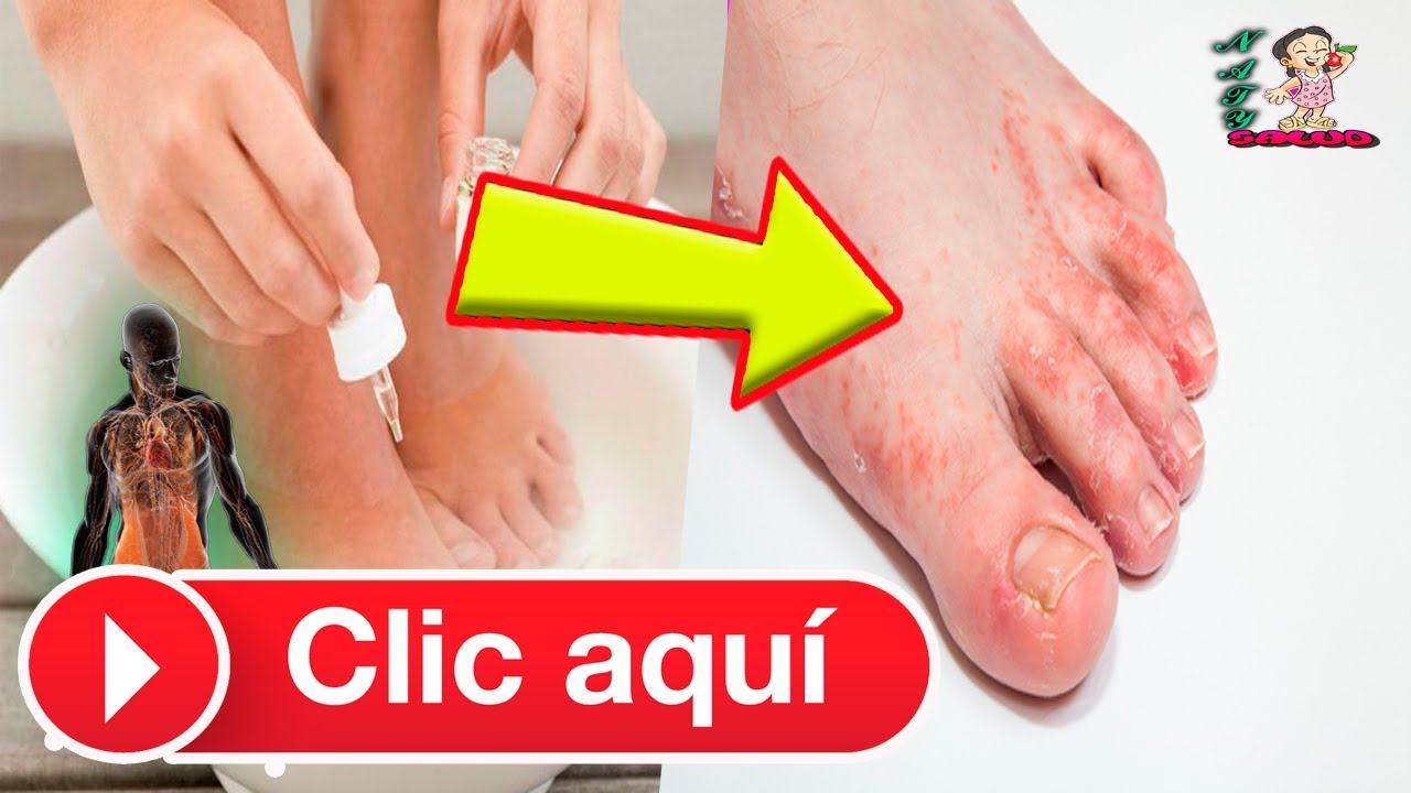 como quitar los hongos delos pies con vinagre blanco