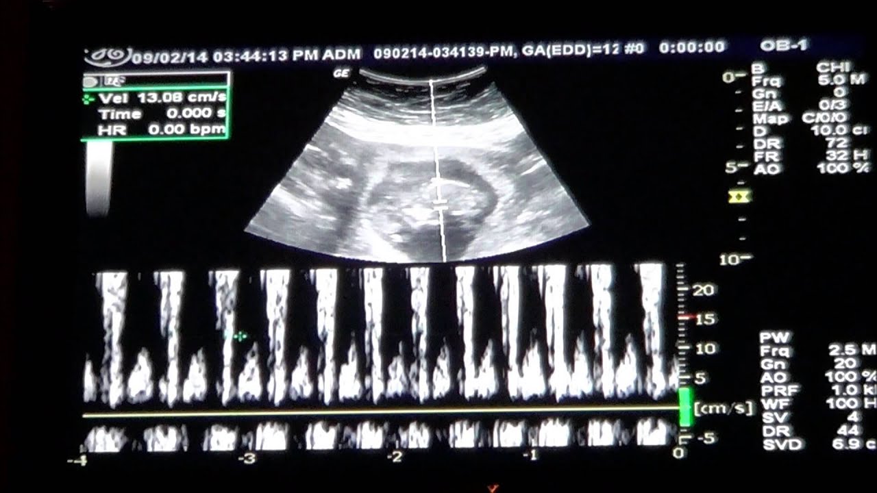 baby boy heartbeat