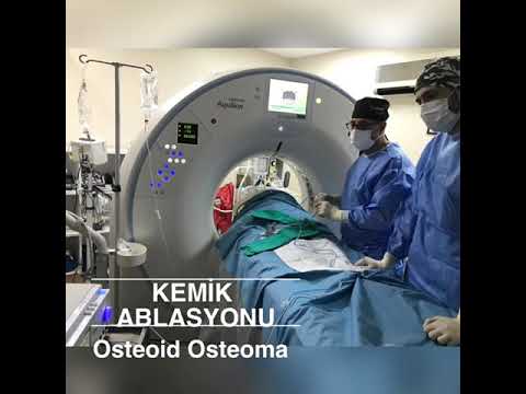 OSTEOİD OSTEOMA