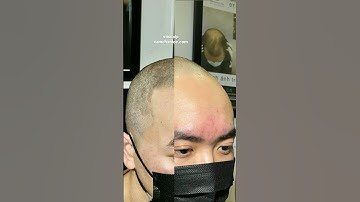 ngạc nhiên chưa!! xăm tóc hói #xămtóc #HóichữM #xămtóc #scalp