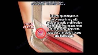 Tennis Elbow Muscle, Extensor Carpi Radialis Brevis -Everything You Need To Know -Dr. Nabil Ebraheim