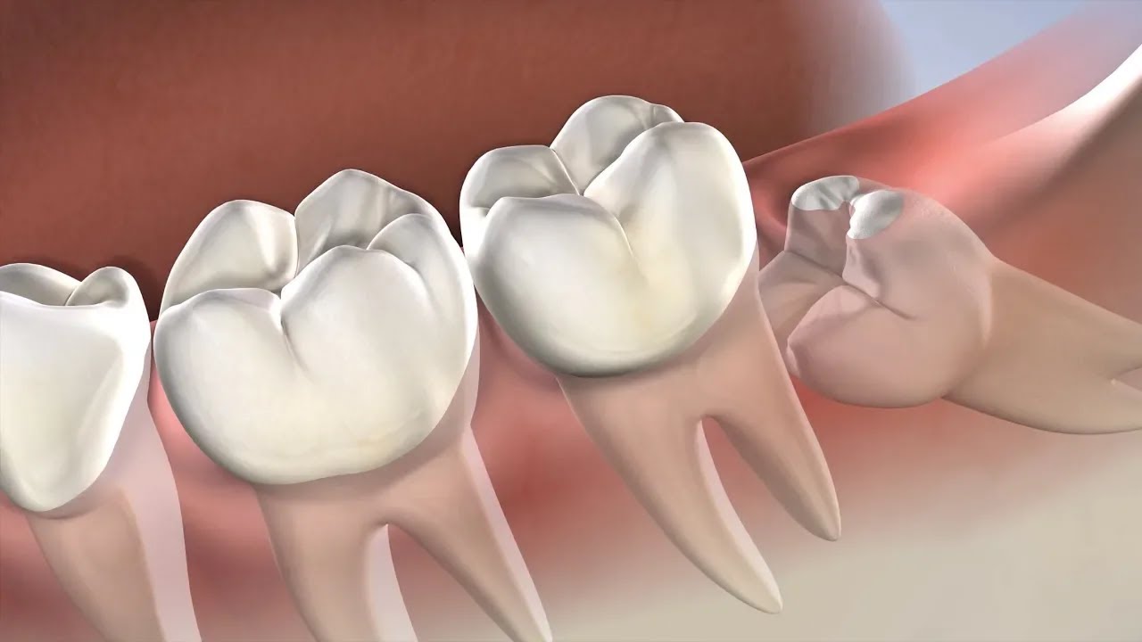 Wisdom Teeth Removal in Dallas TX | Park Cities Oral & Maxillofacial Surgery Associates