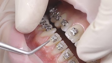 💥 CẬN CẢNH QUY TRÌNH GẮN MẮC CÀI | NIỀNG RĂNG MẮC CÀI - BỆNH VIỆN THÁI THƯỢNG HOÀNG