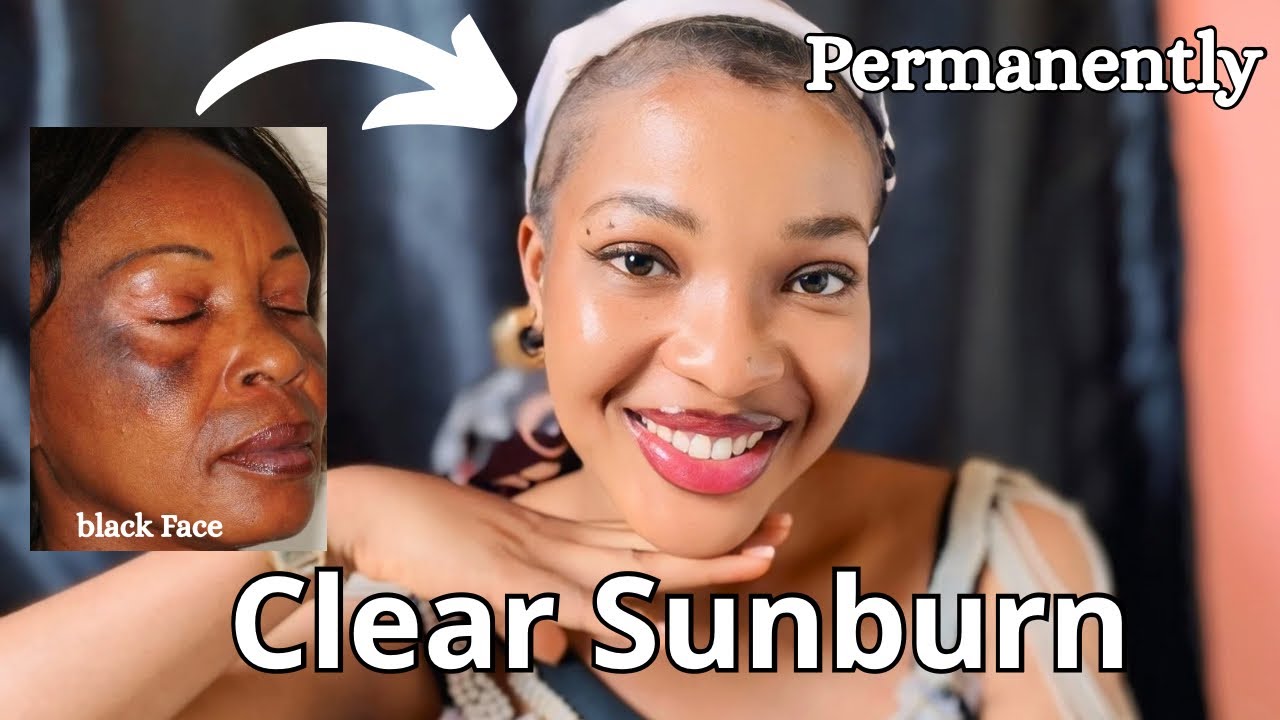 How To Treat Sunburn Quickly |How To clear Sunburn permanently
