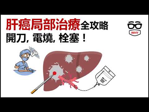 肝癌早期、中期怎麼治？醫師拆解局部治療：開刀、栓塞、電燒怎麼選？