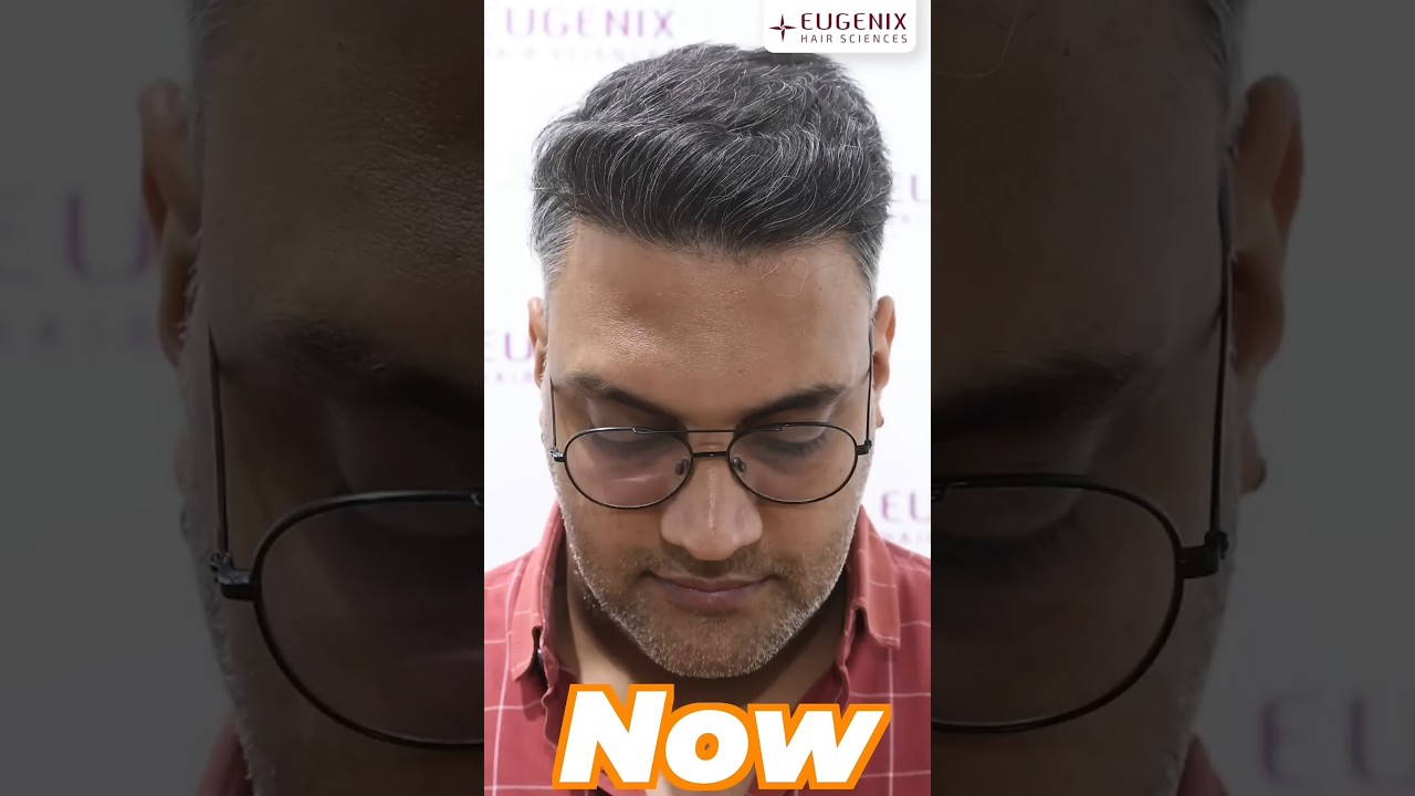 Top Hair Transplant Transformations: Amazing Results You Need to See 