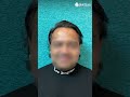 Hair Transplant Before &amp; After | Dr.Jangid | Real Result #beforeafter #hairtransplant #result