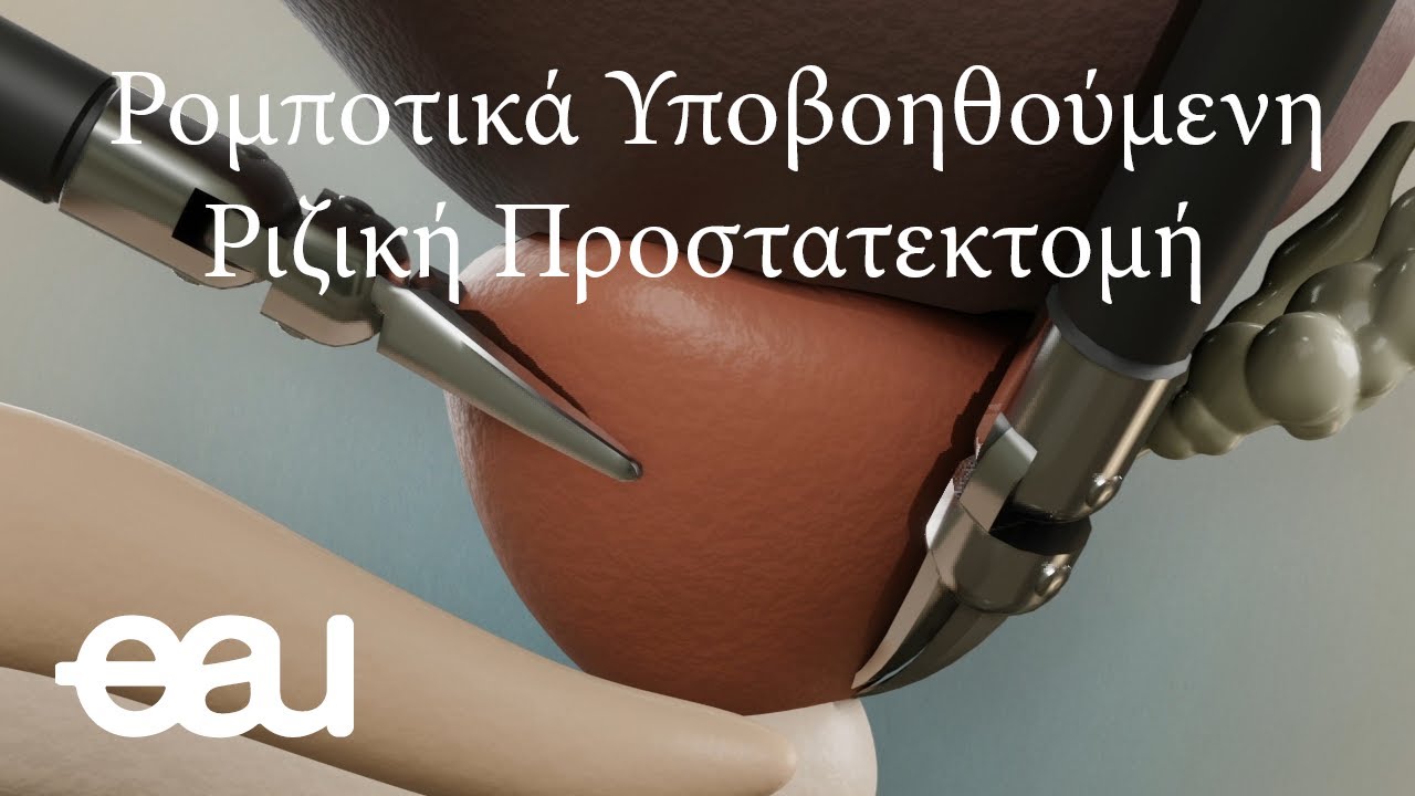 Ρομποτικά Υποβοηθούμενη Ριζική Προστατεκτομή (RARP-GR)