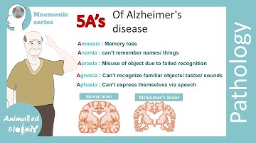 5As of Alzheimer
