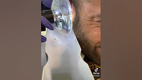 Fighter with cauliflower ear gets earwax removed with Earigator at Memorial Hearing Houston.