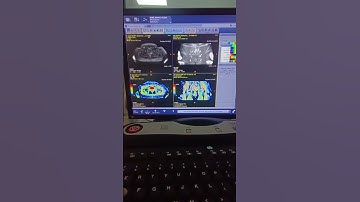 GE MRI: How to Create an ADC Map - Step-by-Step