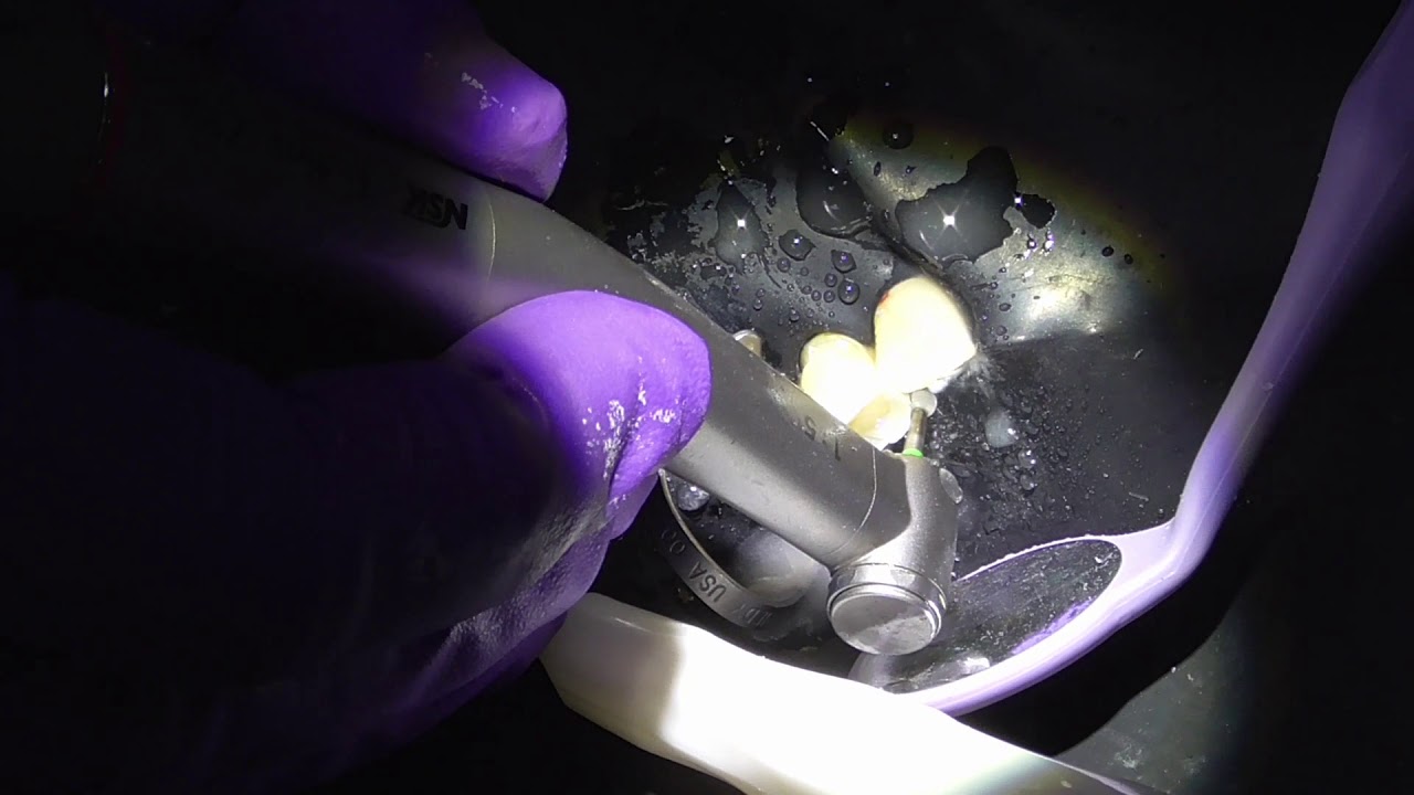 Tooth prep with Rubber dam Dental Clinic