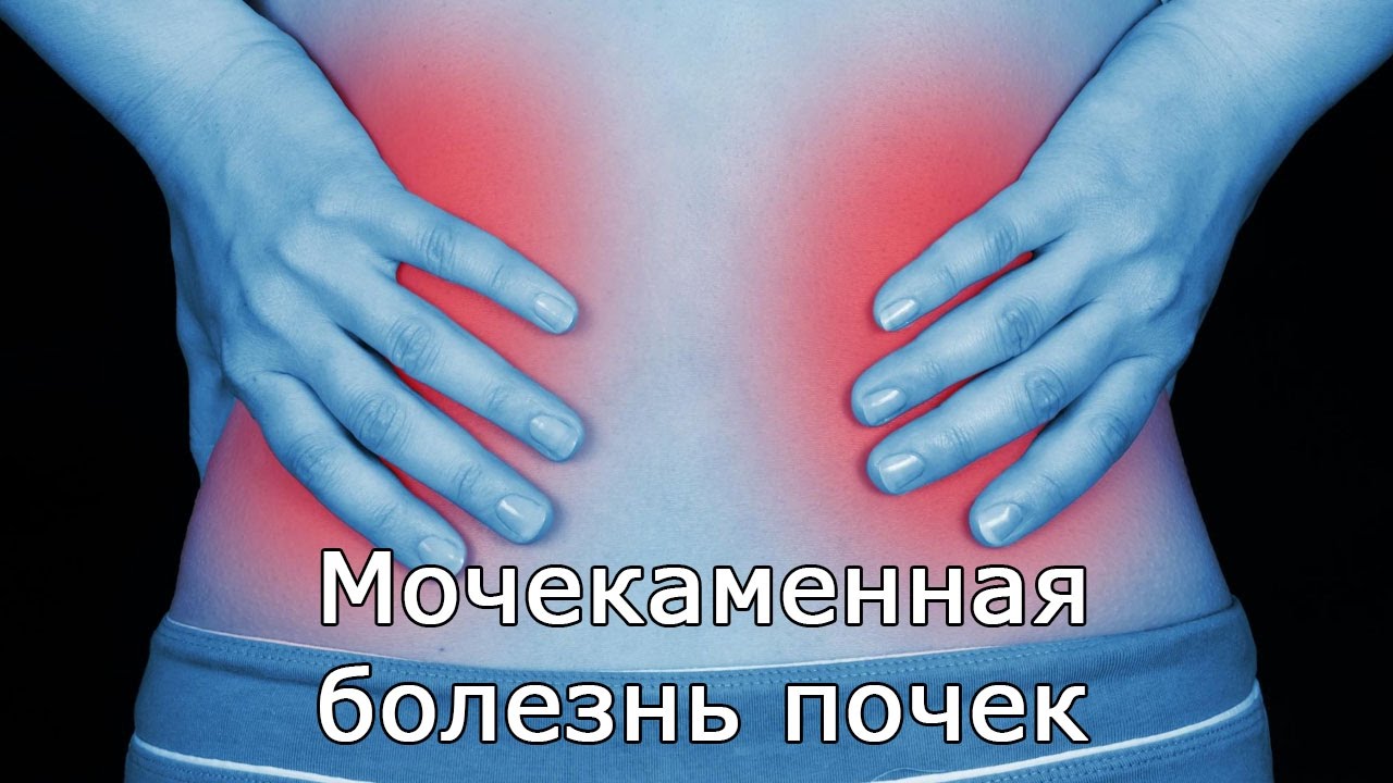 Мочекаменная болезнь почек: симптомы, причины