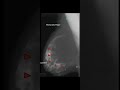 Breast Lipoma Mammography@#@Breast disease@#abnormal Breast@Awerenes of All @##short medical lecture