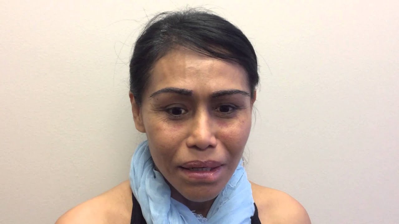 Eyebrow Transplant Testimonial In Spanish You Eyebrow Transplant Testimonial In Spanish