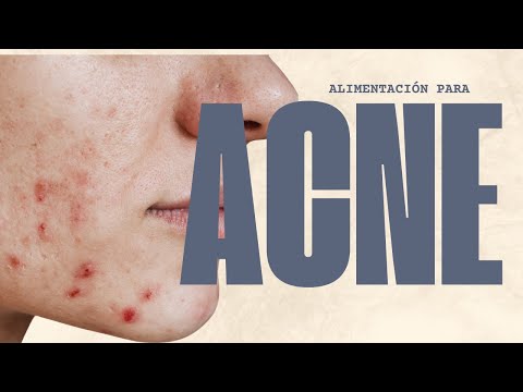 Los mejores alimentos para reducir el acne