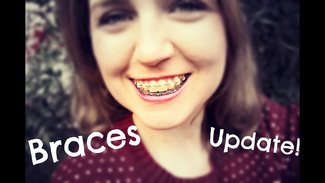 Final Braces Update Getting Them Taken Off Soon Youtube