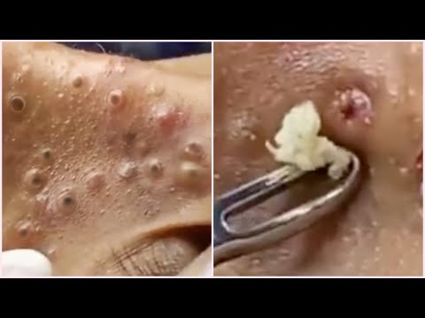 Blackheads on Nose and Forehead - Best Pimple Popping Videos