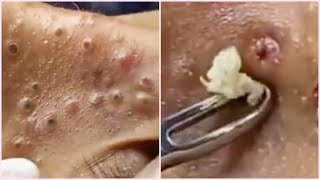 Blackheads on Nose and Forehead - Best Pimple Popping Videos