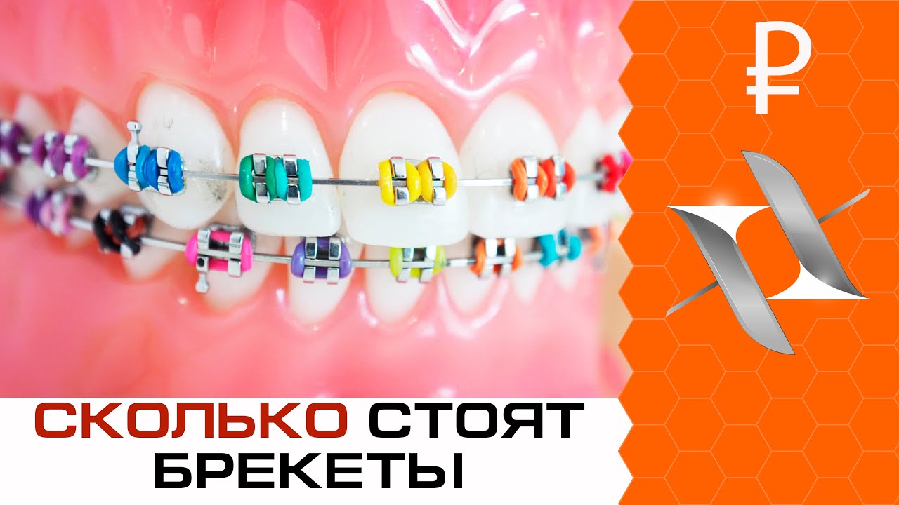 СКОЛЬКО СТОЯТ БРЕКЕТЫ? О маркетинговых уловках клиник и стоимости ...