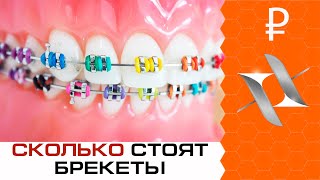 Сколько стоят брекеты? О стоимости ортодонтического лечения(, 2018-03-29T12:02:08.000Z)