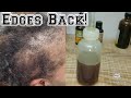 Grow Edges fast with detailed info from specialist/Traction alopecia remedies/DIY Hair growth oil