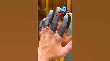 A real look at FROST-BITE of the fingers 🥶🫦 #frostbite #pathology #medschool #medicalstudent