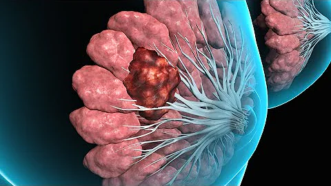 ¿Te anestesian para una biopsia con aguja?