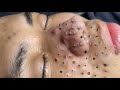 Extreme Blackhead Removal on Nose – Satisfying Deep Cleansing