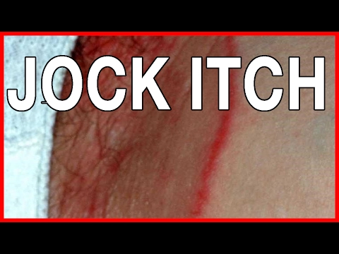 What Is Jock Itch? Natural Secrets To Cure Jock Itch And Home Remedies