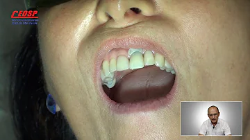 Como fica a gengiva depois do implante Dentario?