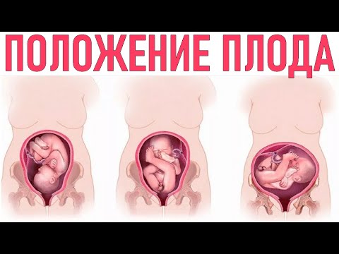 ПРЕДЛЕЖАНИЕ ПЛОДА | Когда ребенок переворачивается вниз головой и что для этого делать