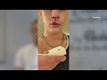 Frederik tog så mange stoffer, at han endte i koma i 3 dage! Nu hjælper han andre misbrugere