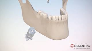Microcone Implant Removal