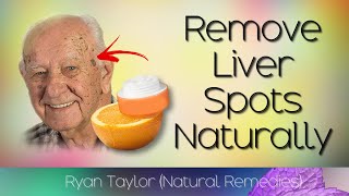 Remove Liver Spots Naturally Age Spots Natural Remedies