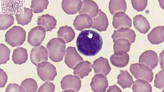 Blood Lymphocyte   cc
