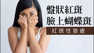 認識紅斑性狼瘡