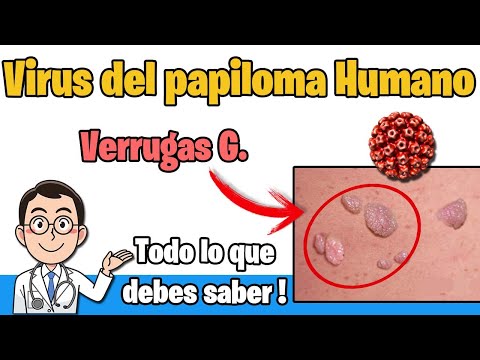 VIRUS del PAPILOMA HUMANO verrugas Sintomas, TRATAMIENTO y PREVENCION VPH | HPV