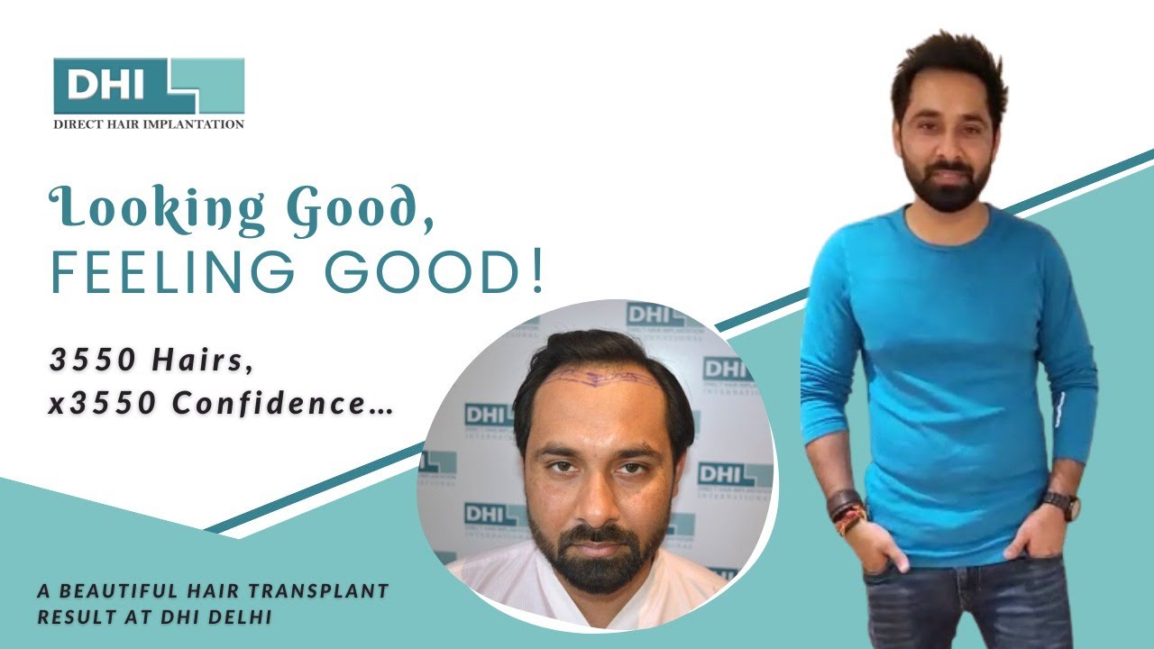 Looking Good, Feeling Good - A Beautiful Hair Transplant Result at DHI Delhi