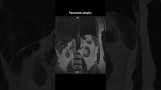 Pancreatic Atrophy Coronal T2