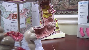 New blood test could catch colon cancer with a colonoscopy