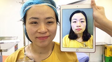 Chỉnh Sửa Đôi Mắt Sụp Mí Bằng PP Cắt Mí Mani Mini Deep 5D Tại Dr.Hải Lê