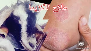 العلاج النهائي للأكزيما و حساسية الجلد وصفة من الطب الشعبي ??فلوق الجديد في الساعات شلي عينيك