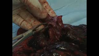 Пример хирургического лечения распространенного рака легкого с поражением трахеи