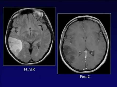 CNS malignancies