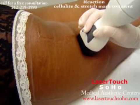 Dark Skin Cellulite &amp; Stretch Marks Treatment.wmv NYC 212 ...