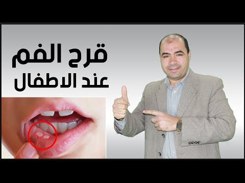 فيديو: كيفية علاج مرض القلاع في فم الطفل