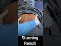 Belly Fat Removal with Liposuction | Amazing Before &amp; After Results 🔥